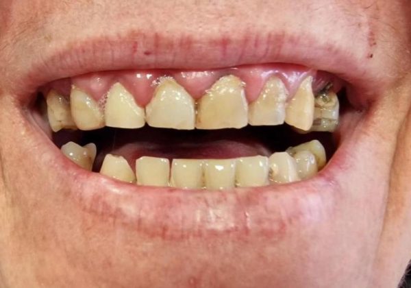 Antes: dientes propios desgastados y separados, con el borde oscurecido y una pieza rota en el lado derecho