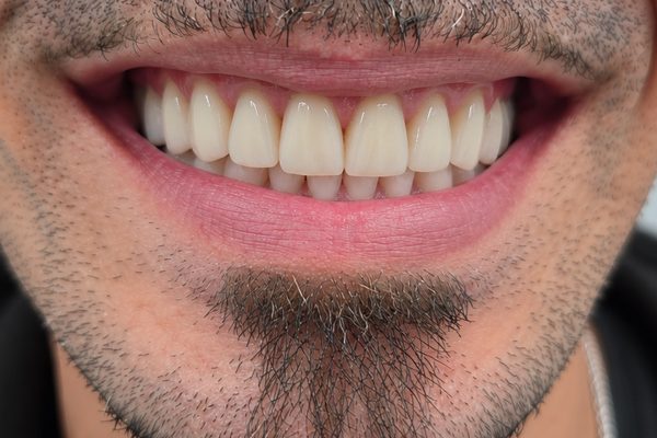 Despu&eacute;s: pr&oacute;tesis fija completa sobre implantes, con las piezas alineadas y la enc&iacute;a sana