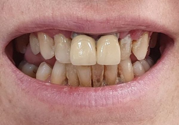 Antes: enc&iacute;a retra&iacute;da, dientes amarillos y desgastados y espacios abiertos entre las piezas