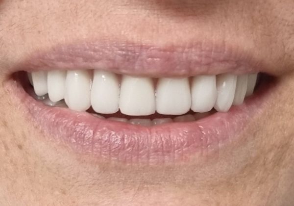 Después: prótesis fija completa sobre implantes, con la encía sana alrededor