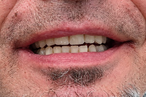 Después: la arcada entera rehabilitada con prótesis fija sobre implantes