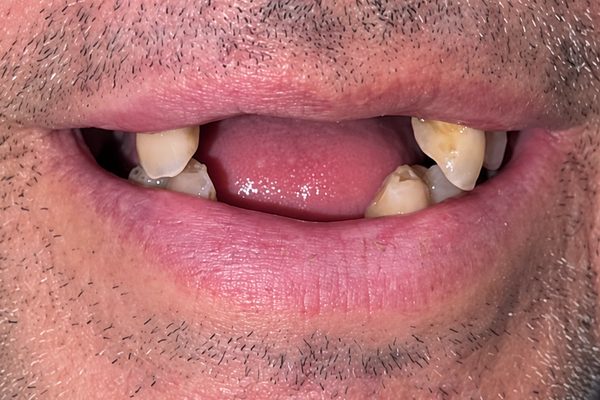 Antes: solo quedan unas piezas sueltas a los lados y entre ellas se ve la enc&iacute;a, sin dientes