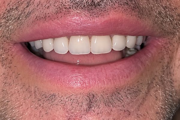 Después: la arcada completa con prótesis fija sobre implantes
