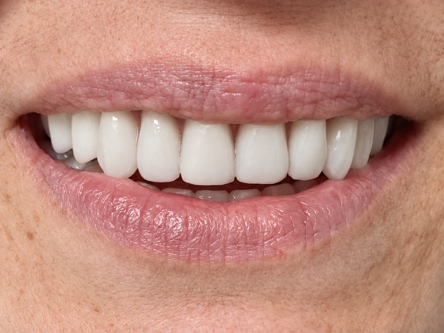 Primer plano de una sonrisa con la pr&oacute;tesis fija ya colocada sobre los implantes
