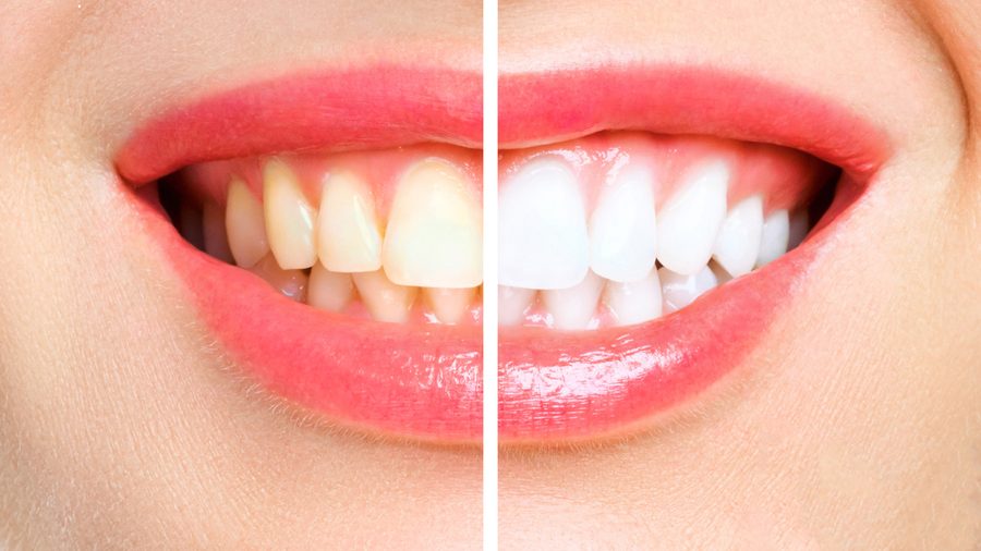 Sonrisa antes y despu&eacute;s de un tratamiento de est&eacute;tica dental