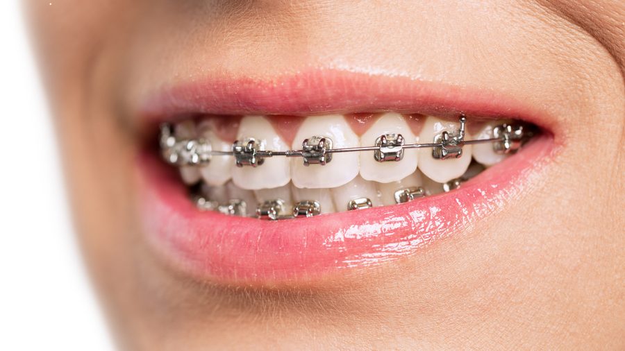 Ortodoncia fija: La opción clásica y eficaz para alinear tus dientes